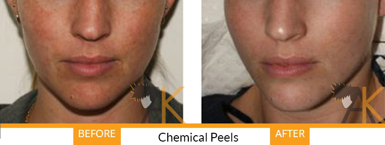 Skin damage caused by facial peels