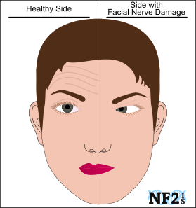 Bazooka reccomend Facial paralysis emedicine
