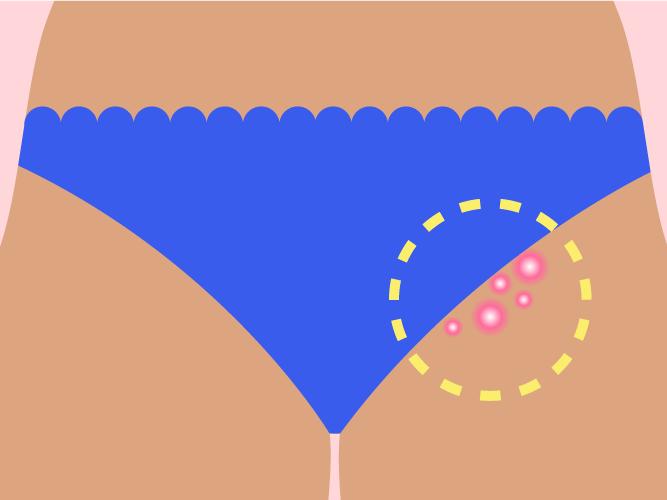 Zelda reccomend Small lump bikini area
