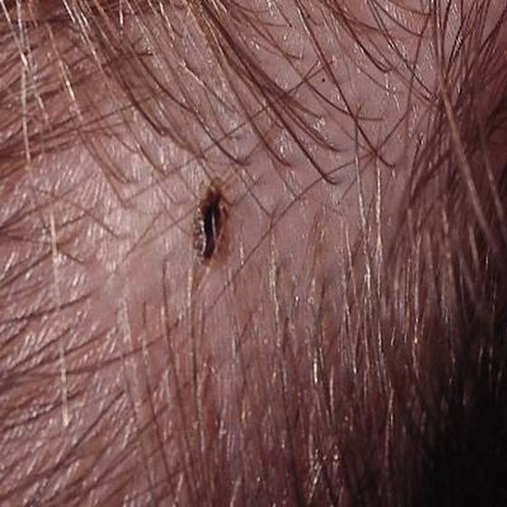 Do adults get head lice