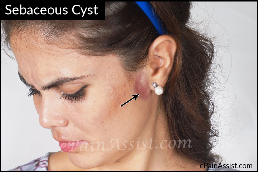 Pictures of epidermoid facial cysts