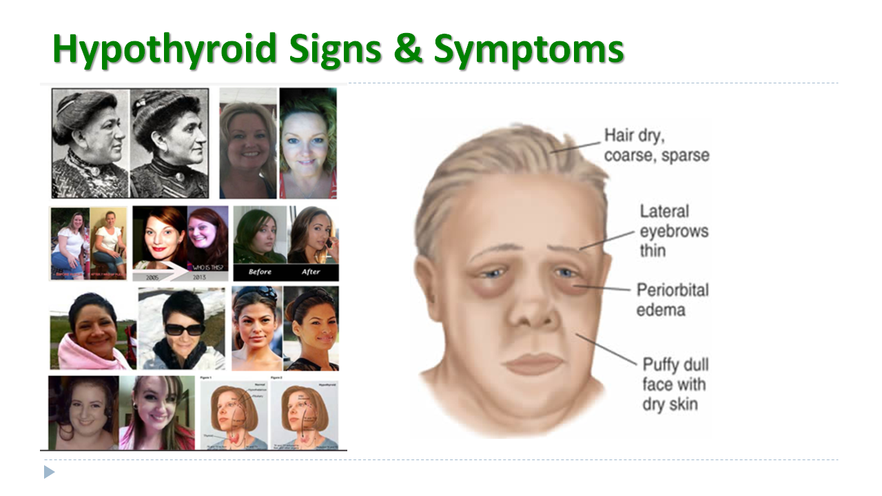 Hypothyroid and facial edema photos