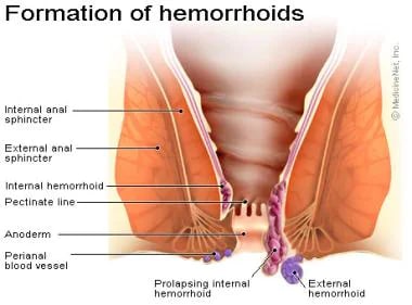best of Hemorrhoids Anus foto