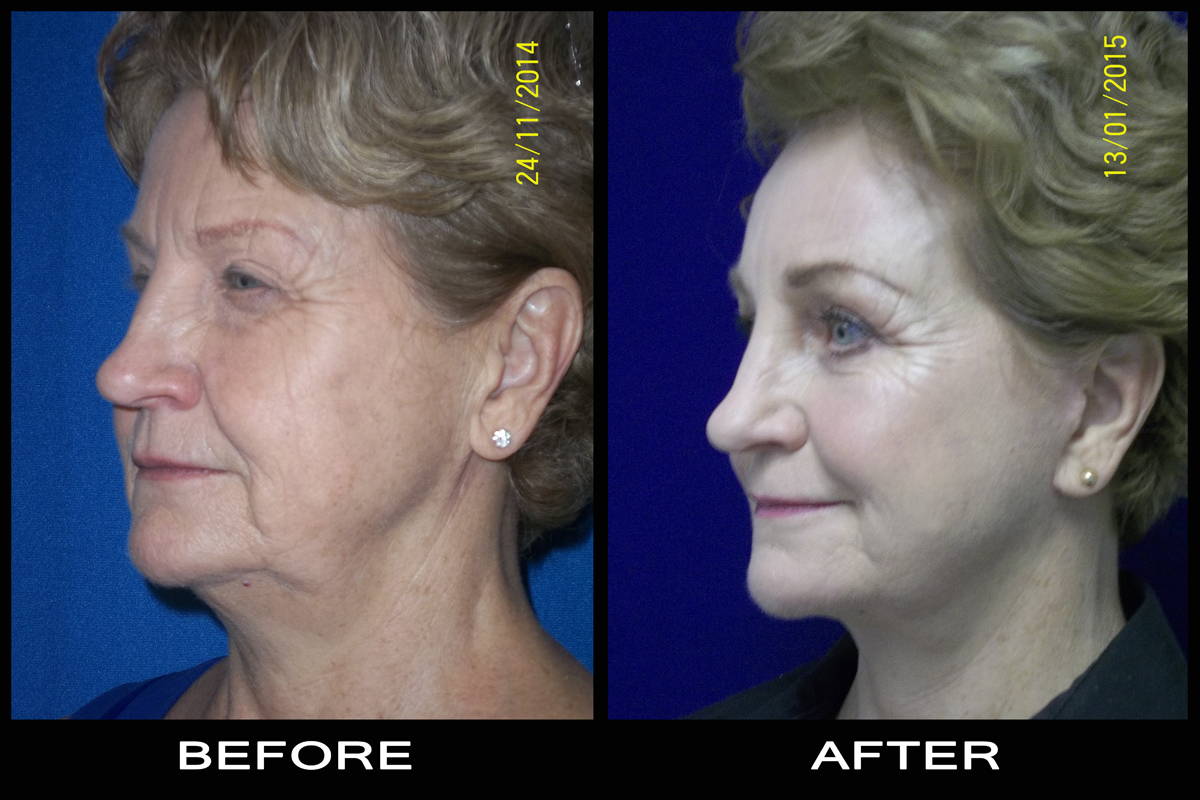 Facial reconstructive plastic surgery tampa