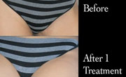 Tator T. reccomend Bikini laser hair removal pain