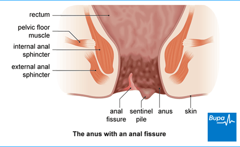 Number S. reccomend Small tear in anus
