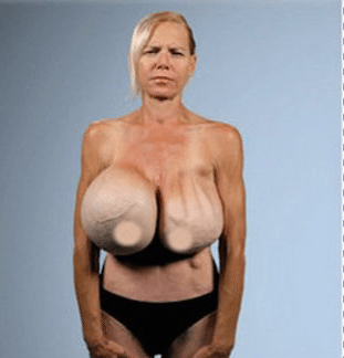 Brown S. reccomend Pictures of boob implants gone wrong
