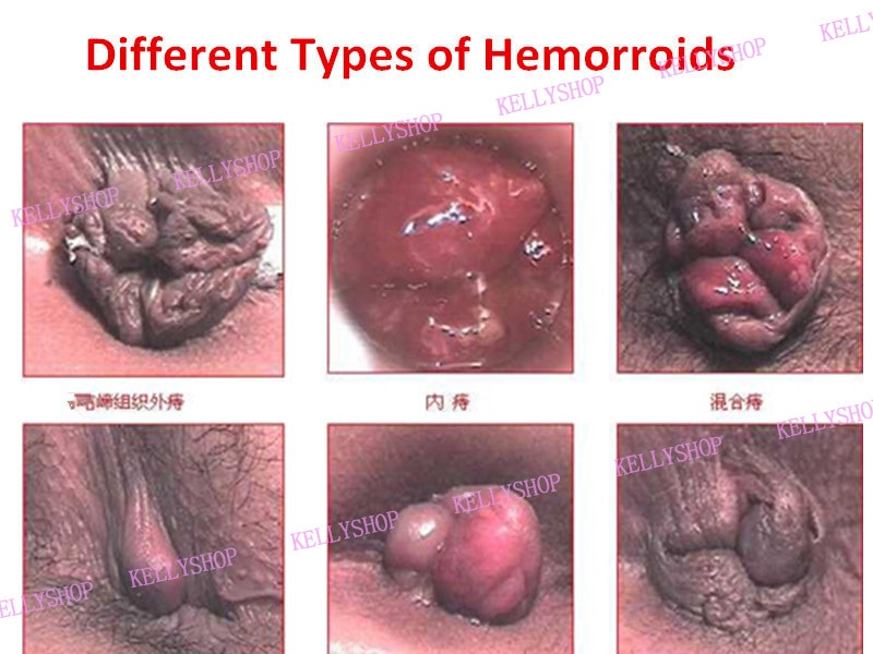 Anus foto hemorrhoids