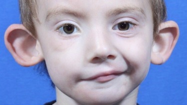 Facial asymmetry in babies