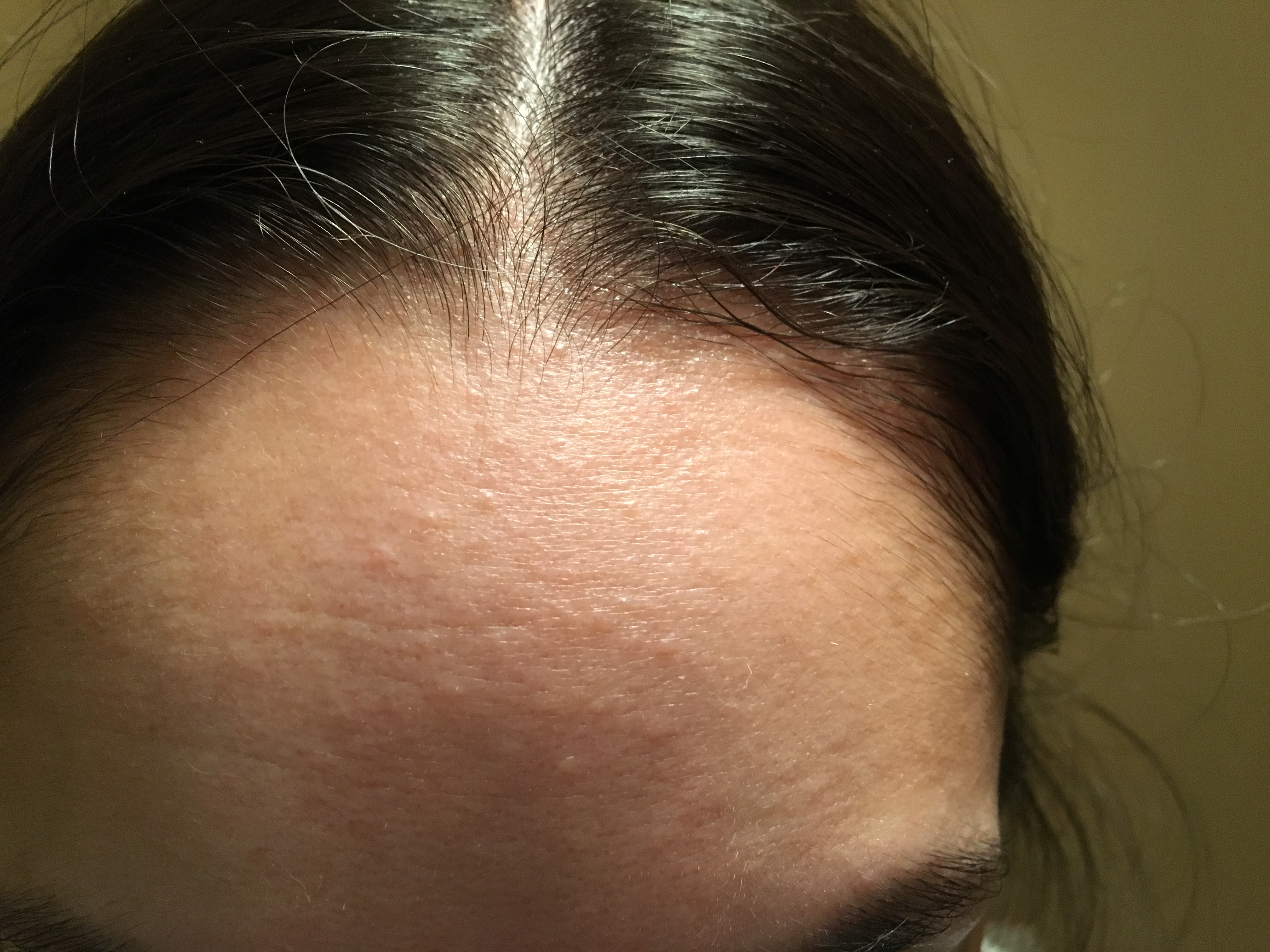 Speed reccomend Facial bumps pictures