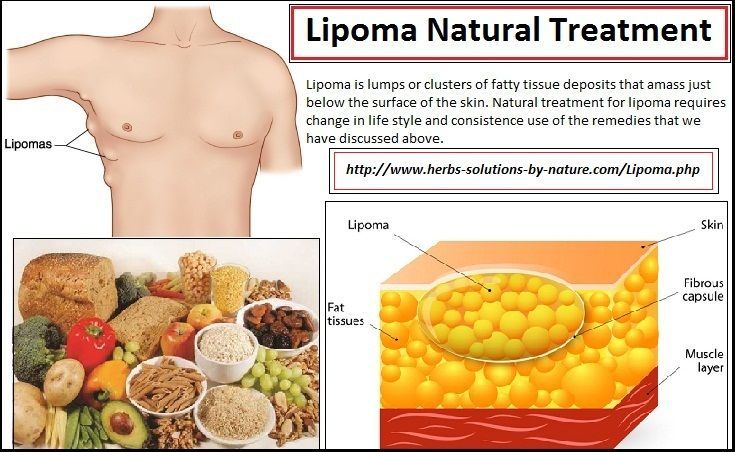 best of Facial lipoma treatments for Natural