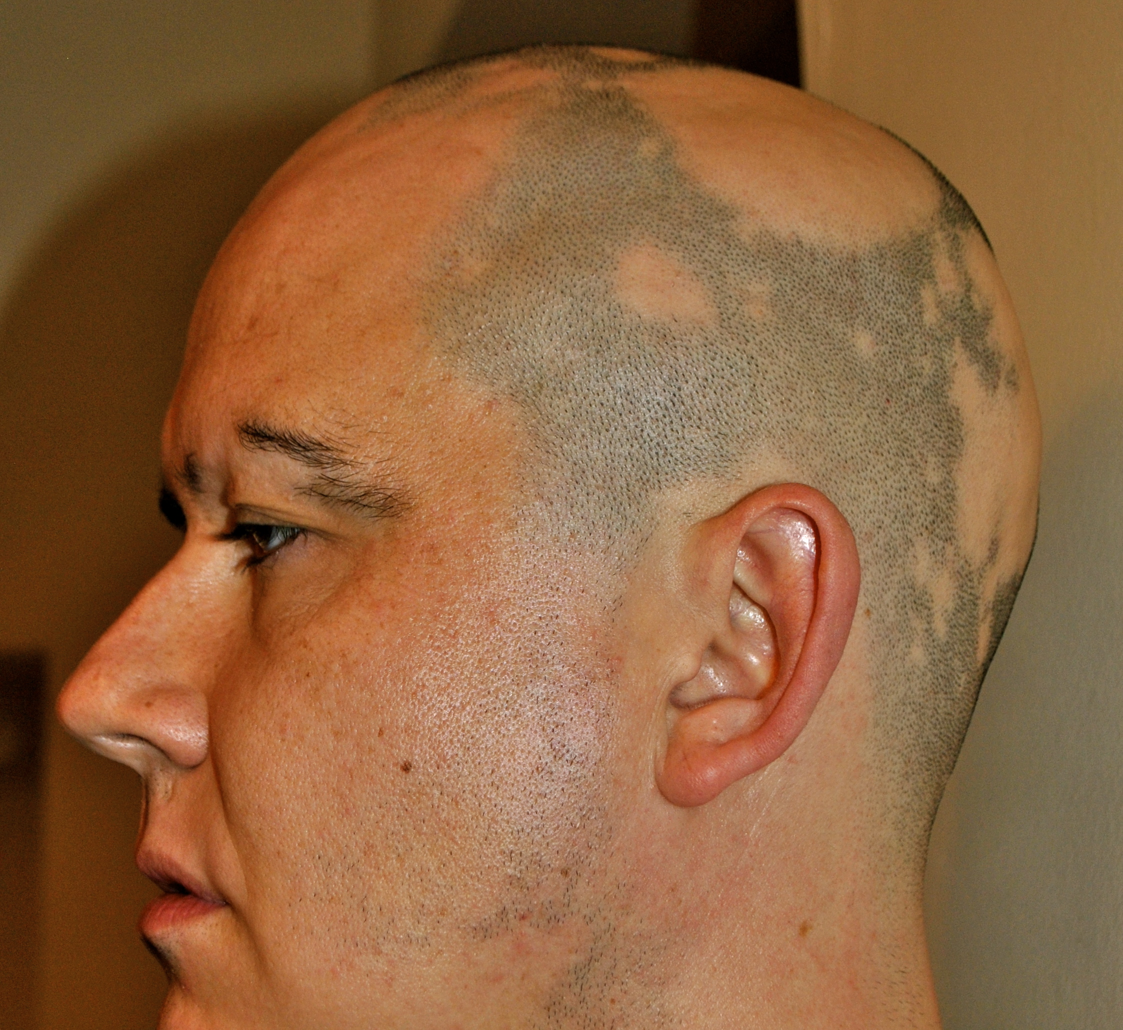 best of Vs shaved area Alopecia