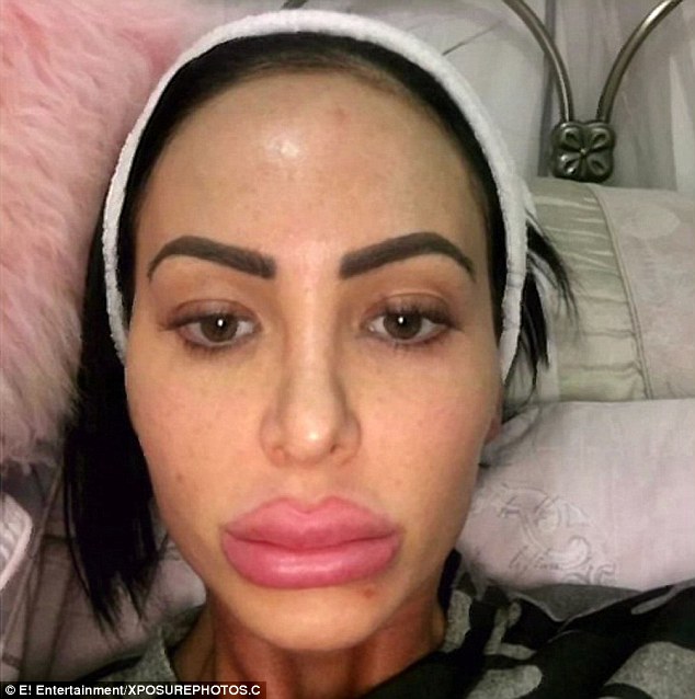 best of Pussy lips in Botox