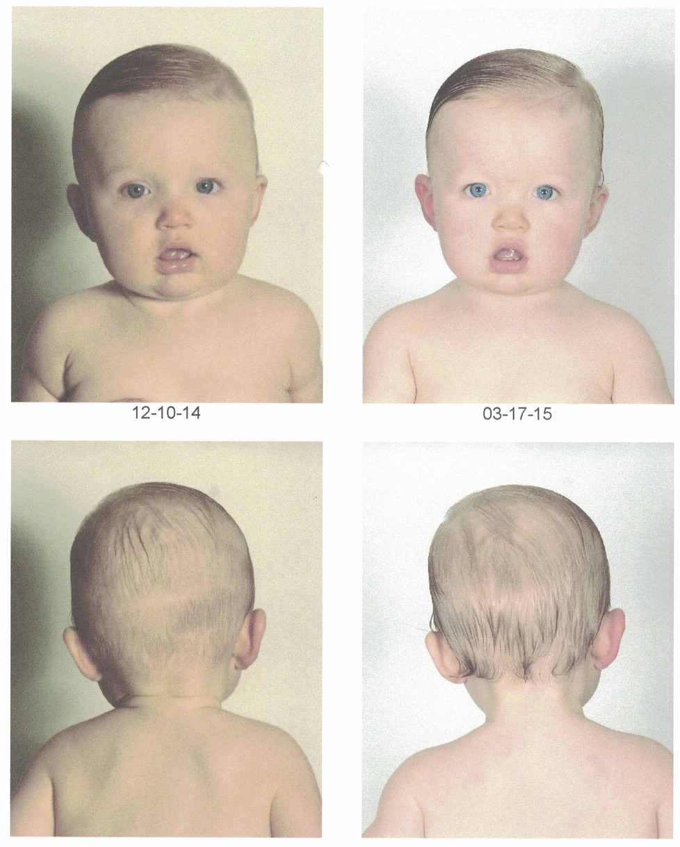 Facial asymmetry in babies