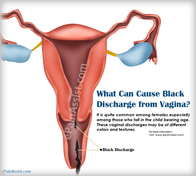 Black secretion from vagina