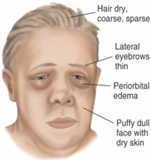 The P. reccomend Hypothyroid and facial edema photos
