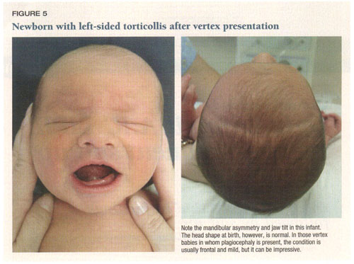 Gear B. reccomend Facial asymmetry in babies