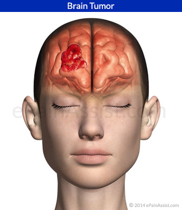Headache edema facial paralysis