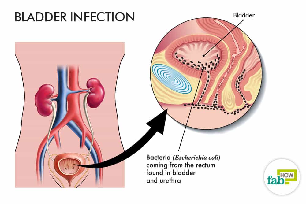 Lincoln reccomend Bladder infection and sex