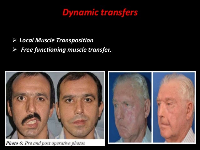 Dynamic facial muscle