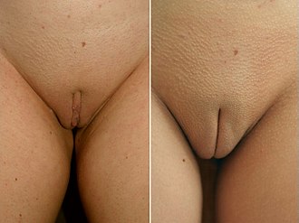 Clitoris reduction surgery