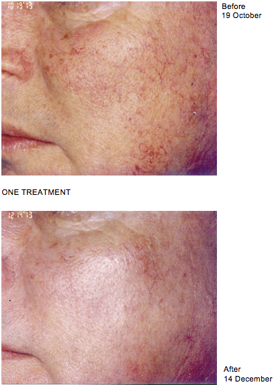 Berlin reccomend Facial spider vein removal brighton and hove east sussex