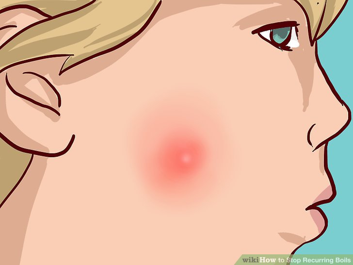 Twilight reccomend Food allergy facial boils