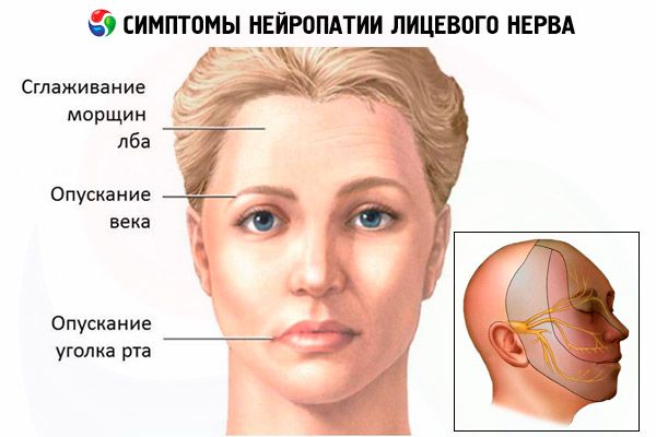 best of Paralysis facial Headache edema