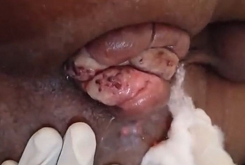 Hemorrhoid outside the anus