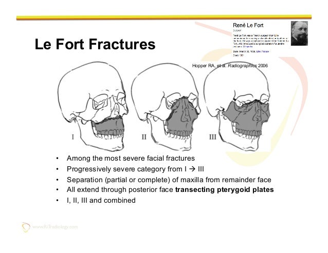 Lefort facial fracture