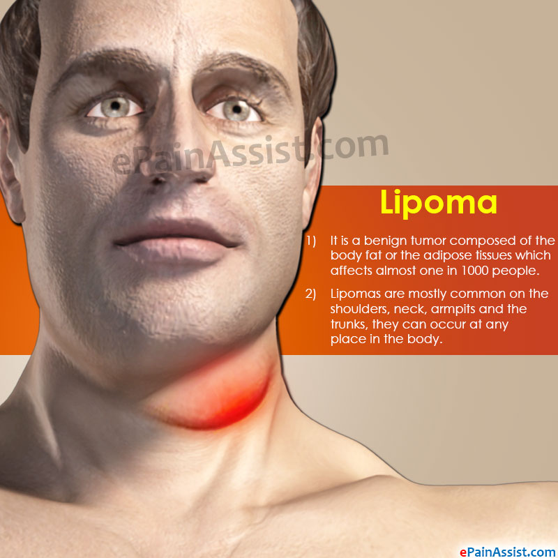 Natural treatments for facial lipoma