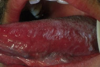 Quirk reccomend Oral hairy leukoplakia and picture